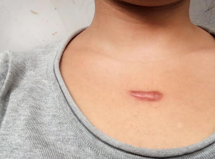 如何正確使用兒童疤痕凝膠，讓孩子遠(yuǎn)離疤痕