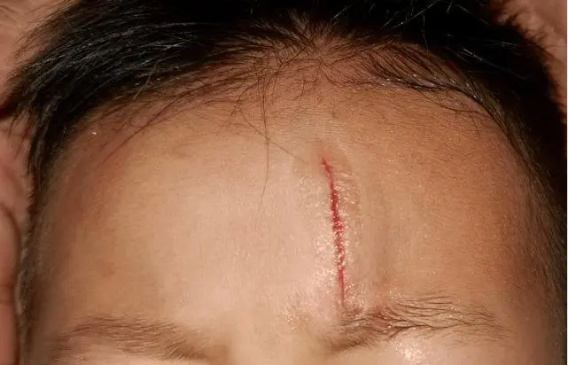 兒童疤痕凝膠，讓孩子即使有疤痕也擁有完美肌膚